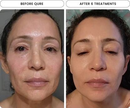 Radiant Skin Micro-Infusion System™