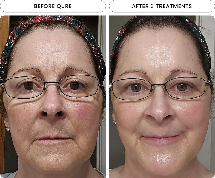 Radiant Skin Micro-Infusion System™