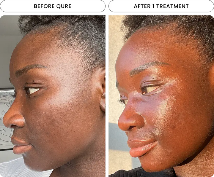 Radiant Skin Micro-Infusion System™