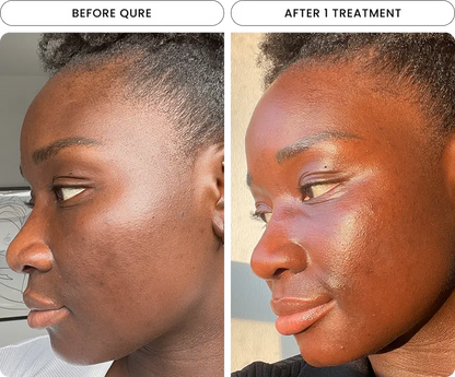 Radiant Skin Micro-Infusion System™