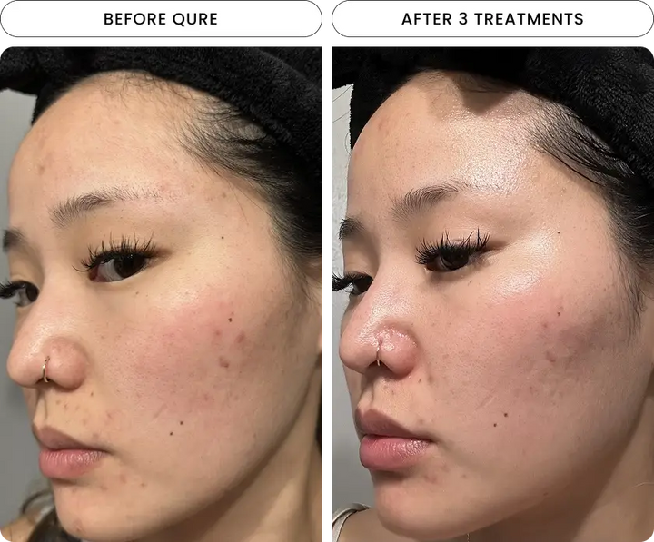 Radiant Skin Micro-Infusion System™