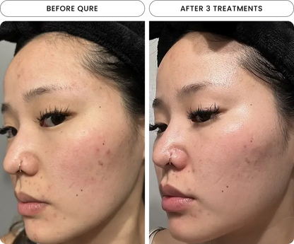 Radiant Skin Micro-Infusion System™